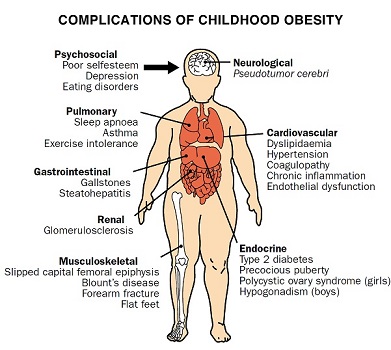 childhood_obesity_complications Made Smaller